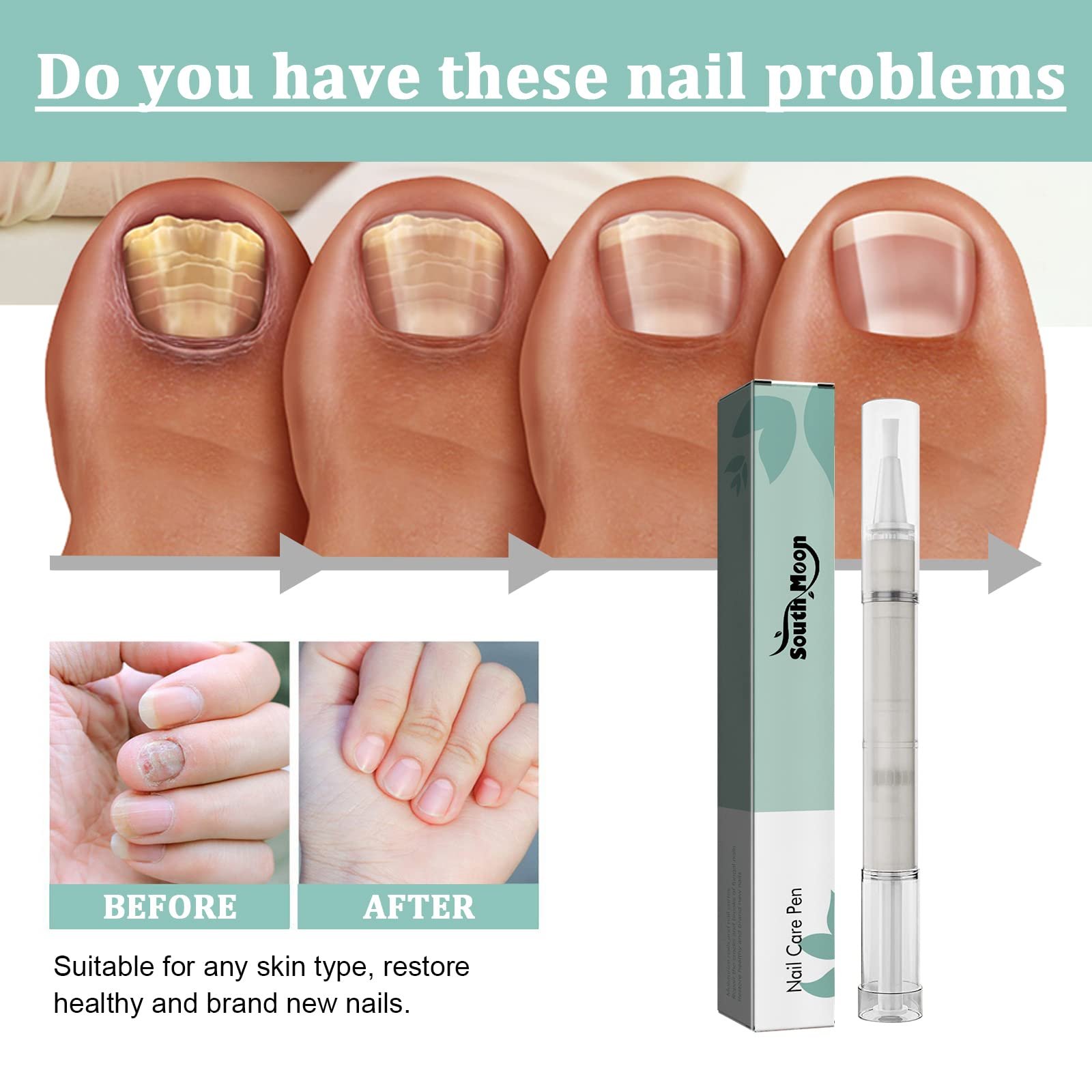 Nail Care Pen, Nail Repair Pen for Repairing Broken Nails Ongle et ...